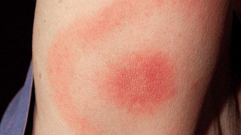 Borreliosis, Lyme disease, tick bite
