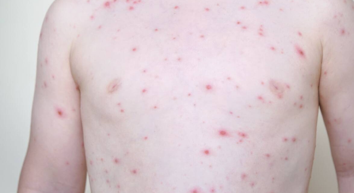 Chickenpox․ How to recognize a rash, who is at risk?