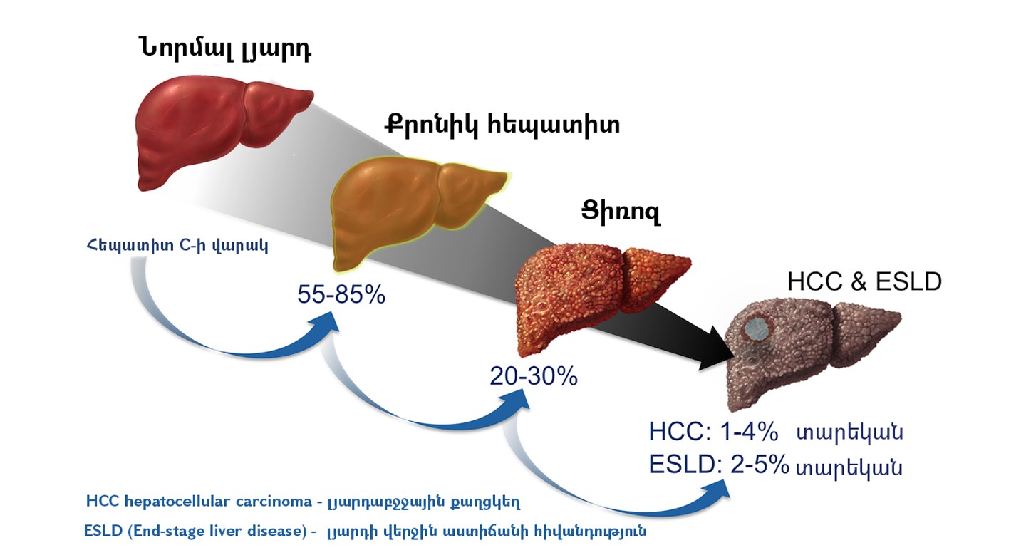 Հայաստանի Հանրապետությունում ինչպե՞ս է հեպատիտ Ց-ի բուժման կարգը